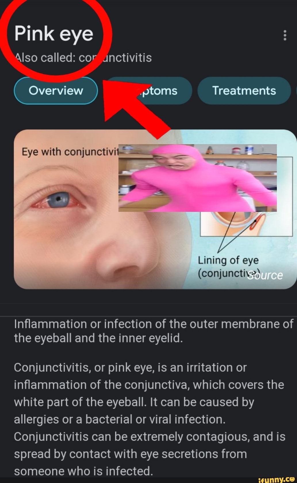 Pink Eye Also Called Cor Unctivitis Eye With Conjunctivi Overview