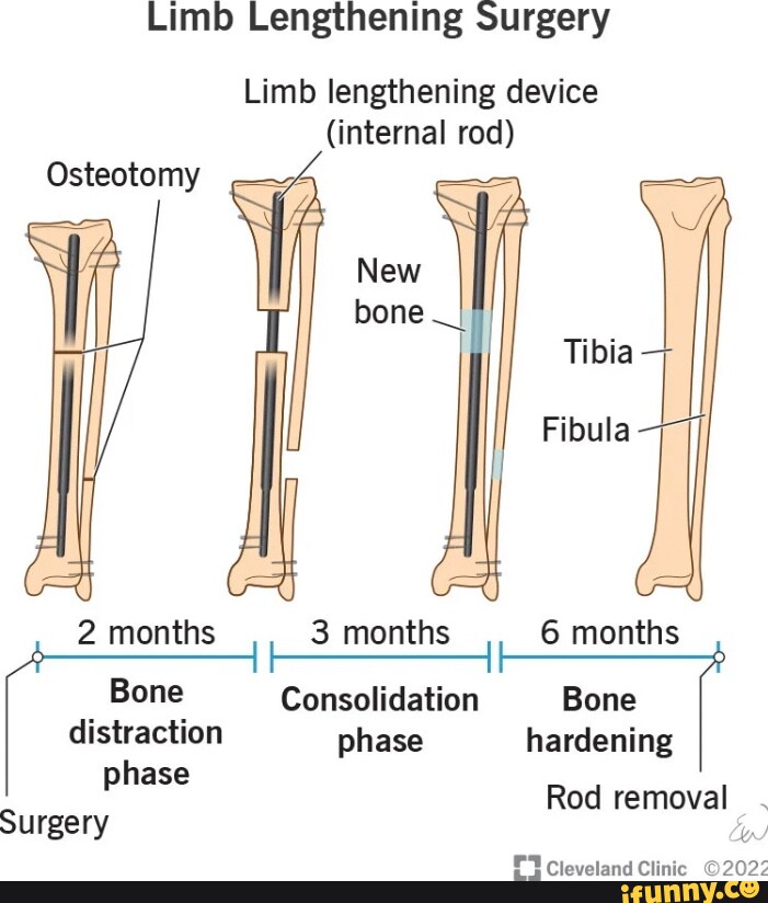 limb-lengthening-surgery-limb-lengthening-device-internal-rod