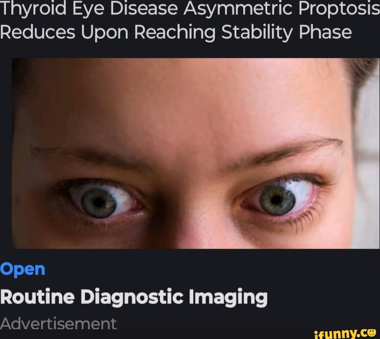 Thyroid Eye Disease Asymmetric Proptosis Reduces Upon Reaching