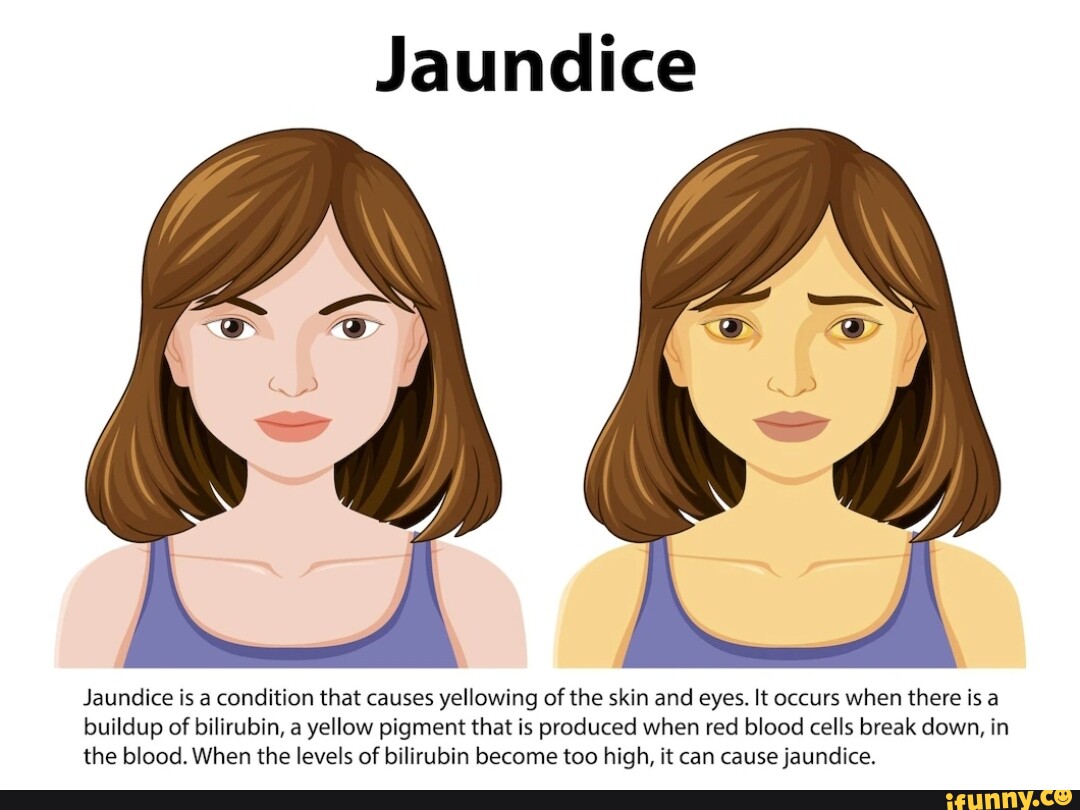 Jaundice Jaundice is a condition that causes yellowing of the skin and eyes. It occurs when