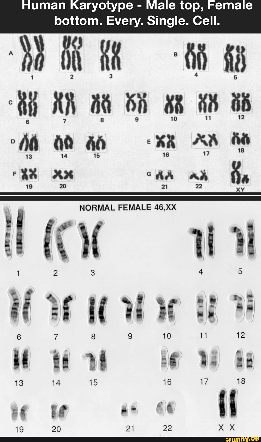 xo karyotype