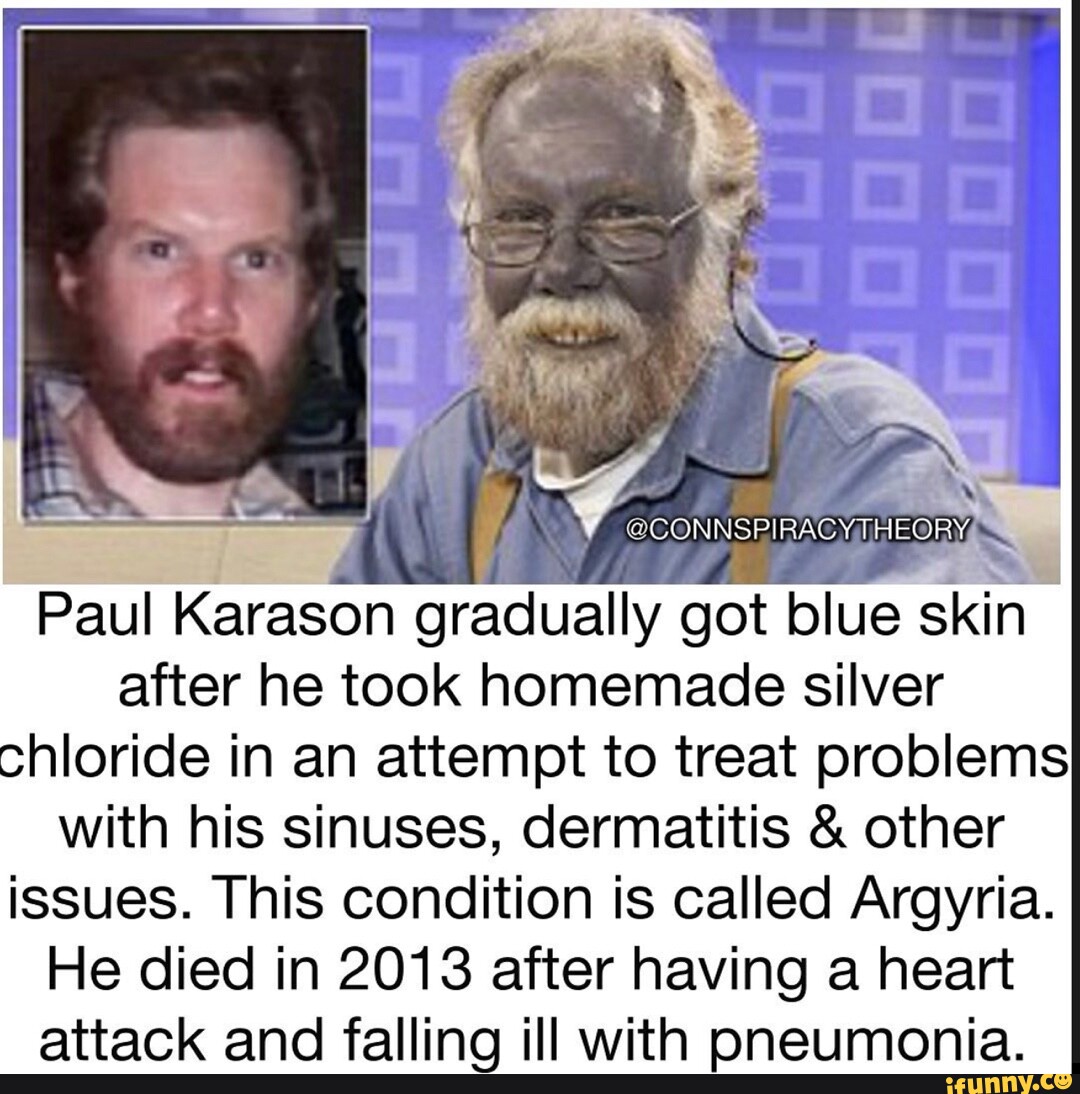 Paul Karason  The Man With Blue Skin 