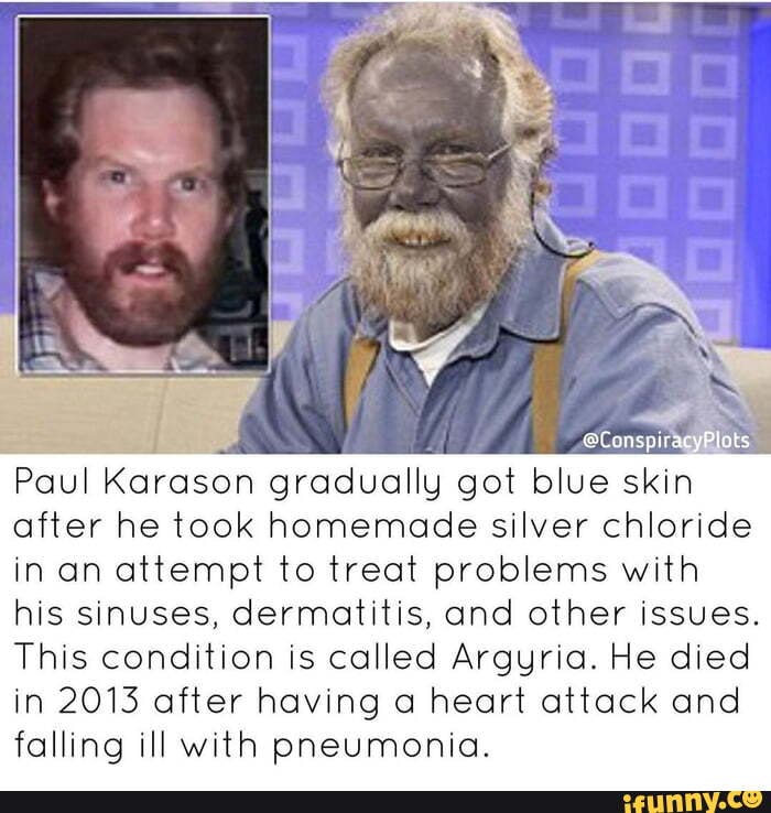 Real life 'blue man' Paul Karason dies aged 62; turned blue after drinking  colloidal silver to help skin