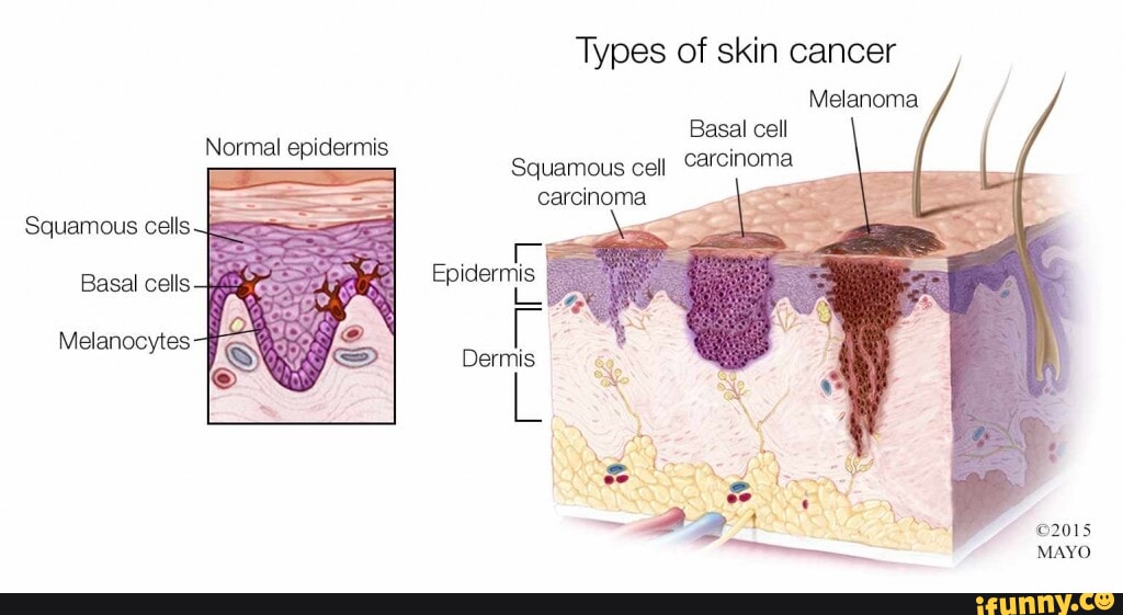 Squamous cells Normal epidermis Basal cells + Melanocytes Types of skin ...