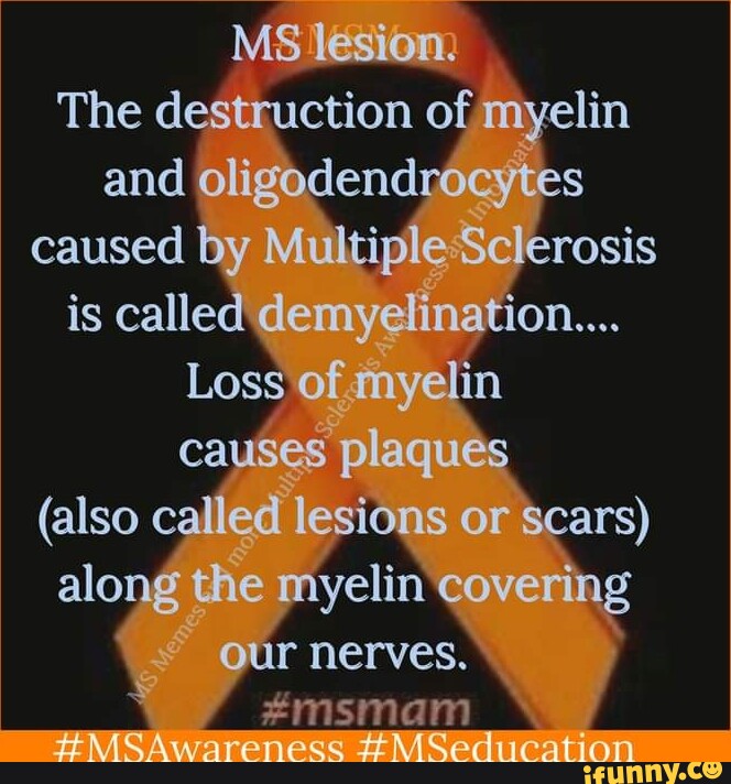 MS lesion. The destruction of myelin and oligodendrocytes caused by ...